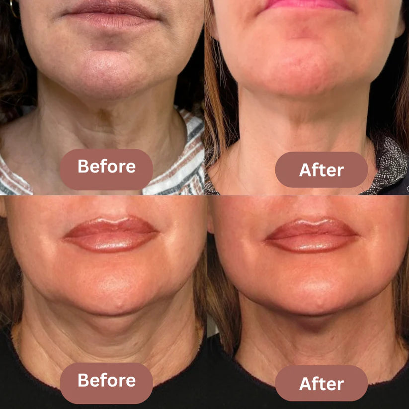 VivaSculpter's Face Shaper